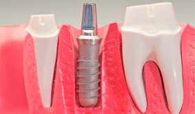 Clínica Dental Remei Gomà prótesis dental